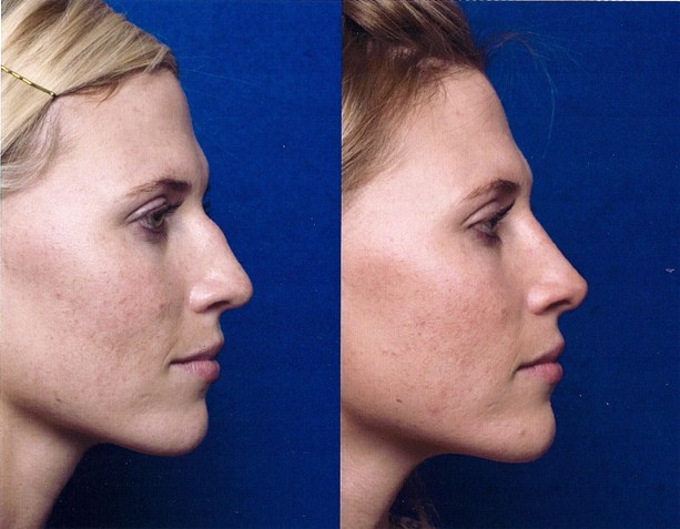 The Nose Clinic Before And After Nose Surgery Photos 41